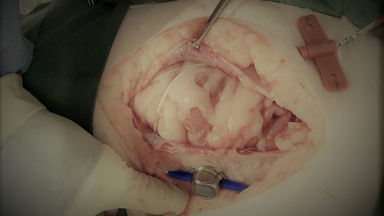 SABシステムを使った猫の尿管結石手術【写真あり】
